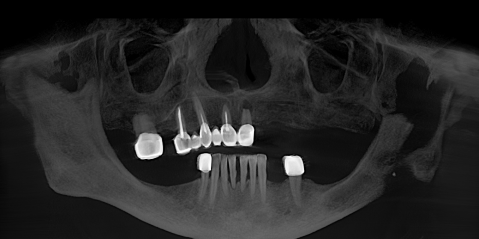 Від знімних протезів до імплантів Straumann в 73 роки