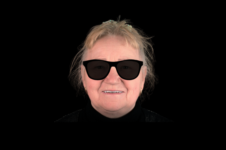 От съемных протезов к имплантам Straumann в 73 года