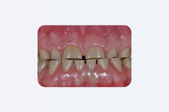 7 ознак старіння зубів, як перевірити і що робити