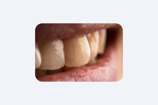 7 ознак старіння зубів, як перевірити і що робити