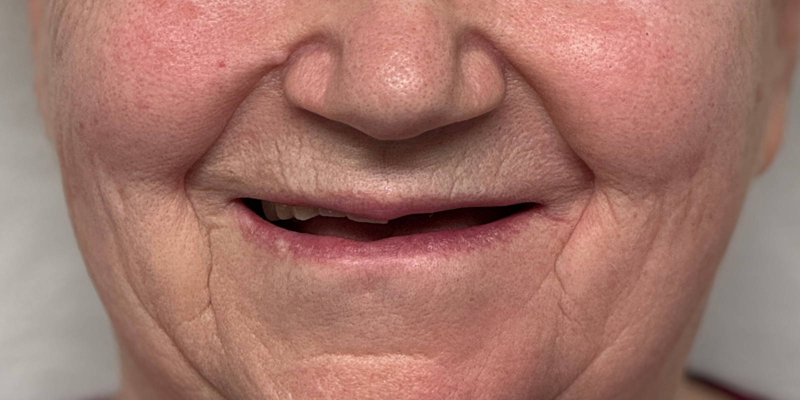 Від знімних протезів до імплантів Straumann в 73 роки