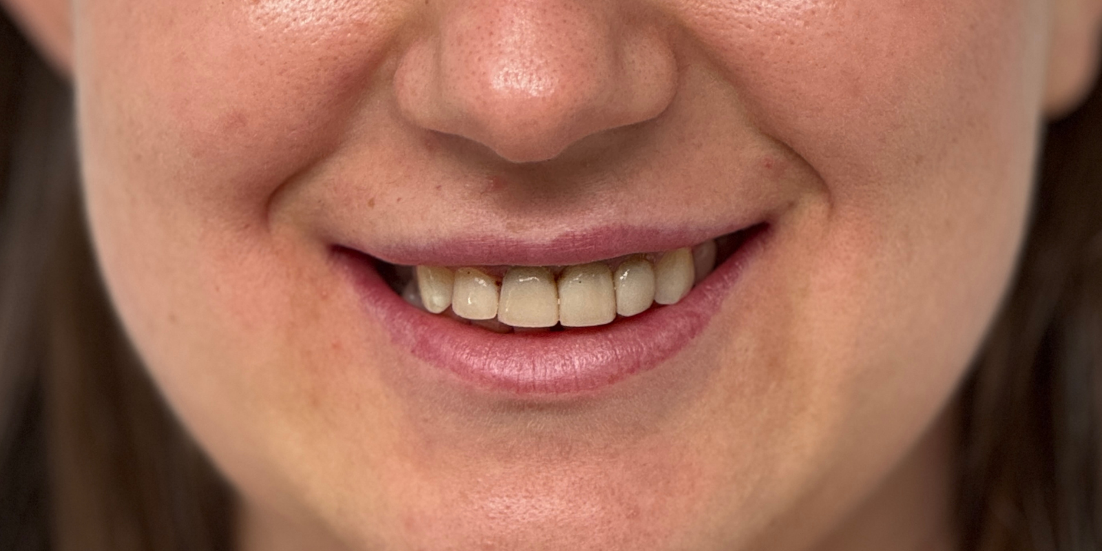 Керамічні вініри й коронки всього за 1 тиждень