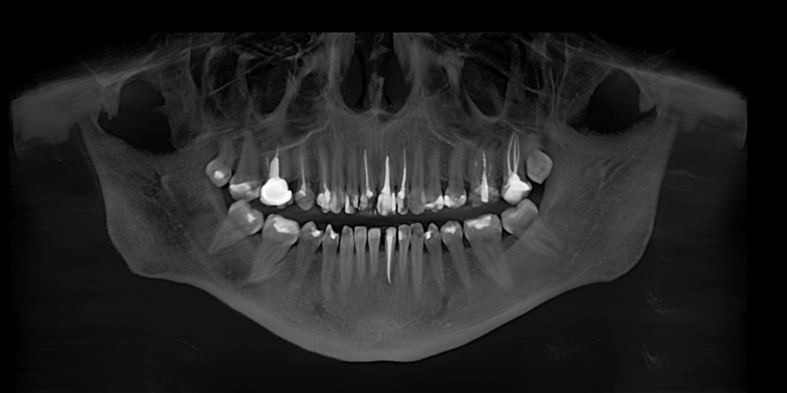 Керамічні вініри й коронки всього за 1 тиждень