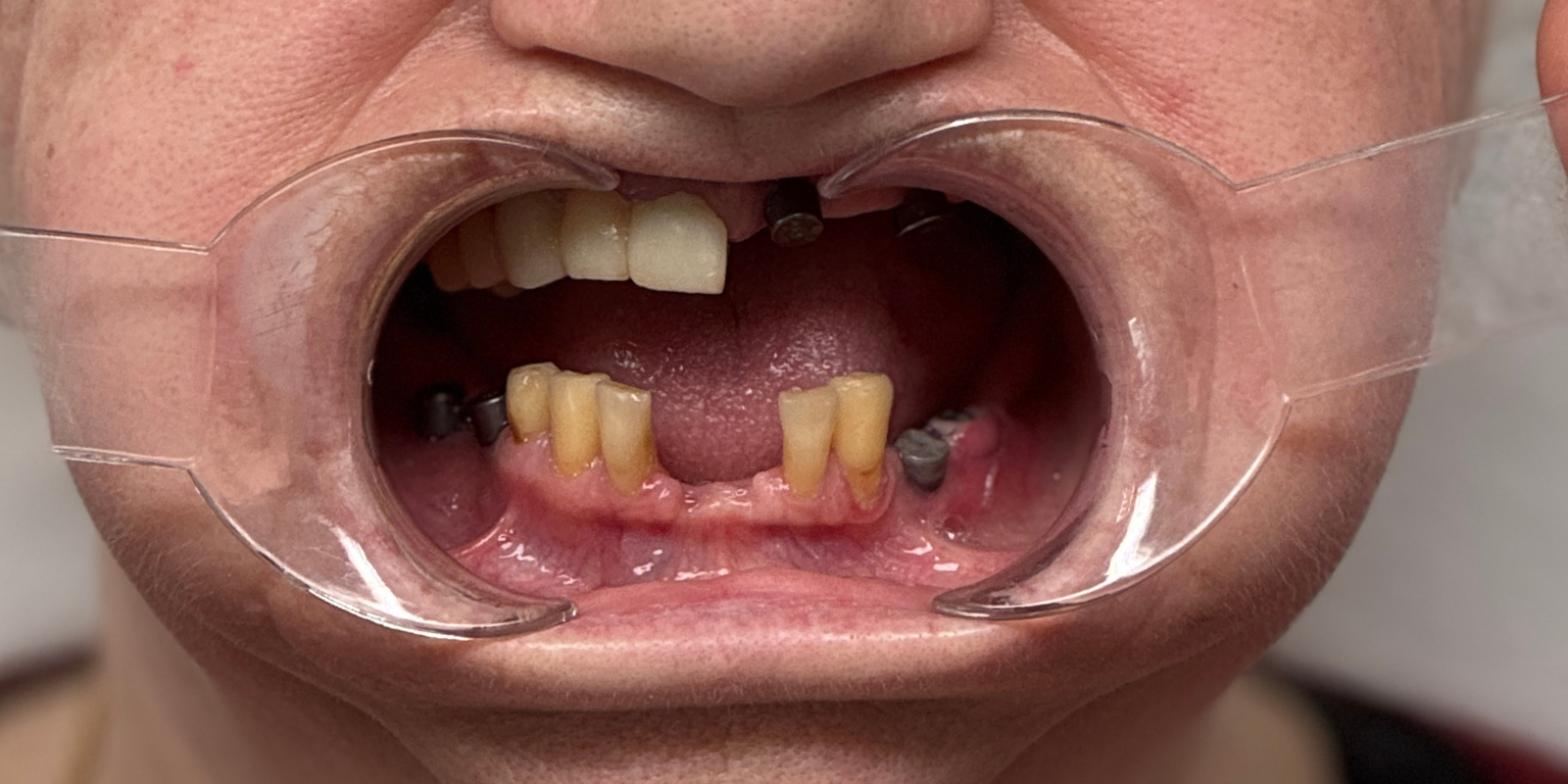 Від знімних протезів до імплантів Straumann в 73 роки