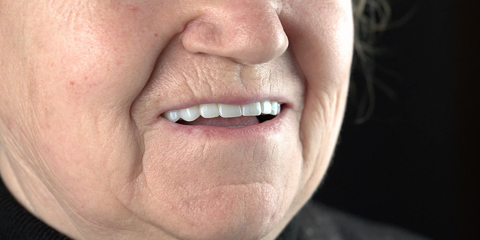 Від знімних протезів до імплантів Straumann в 73 роки