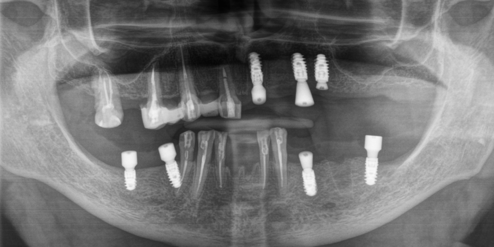 Від знімних протезів до імплантів Straumann в 73 роки