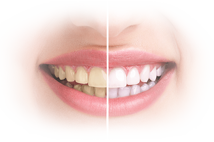 Все про відбілювання зубів вдома та в стоматології