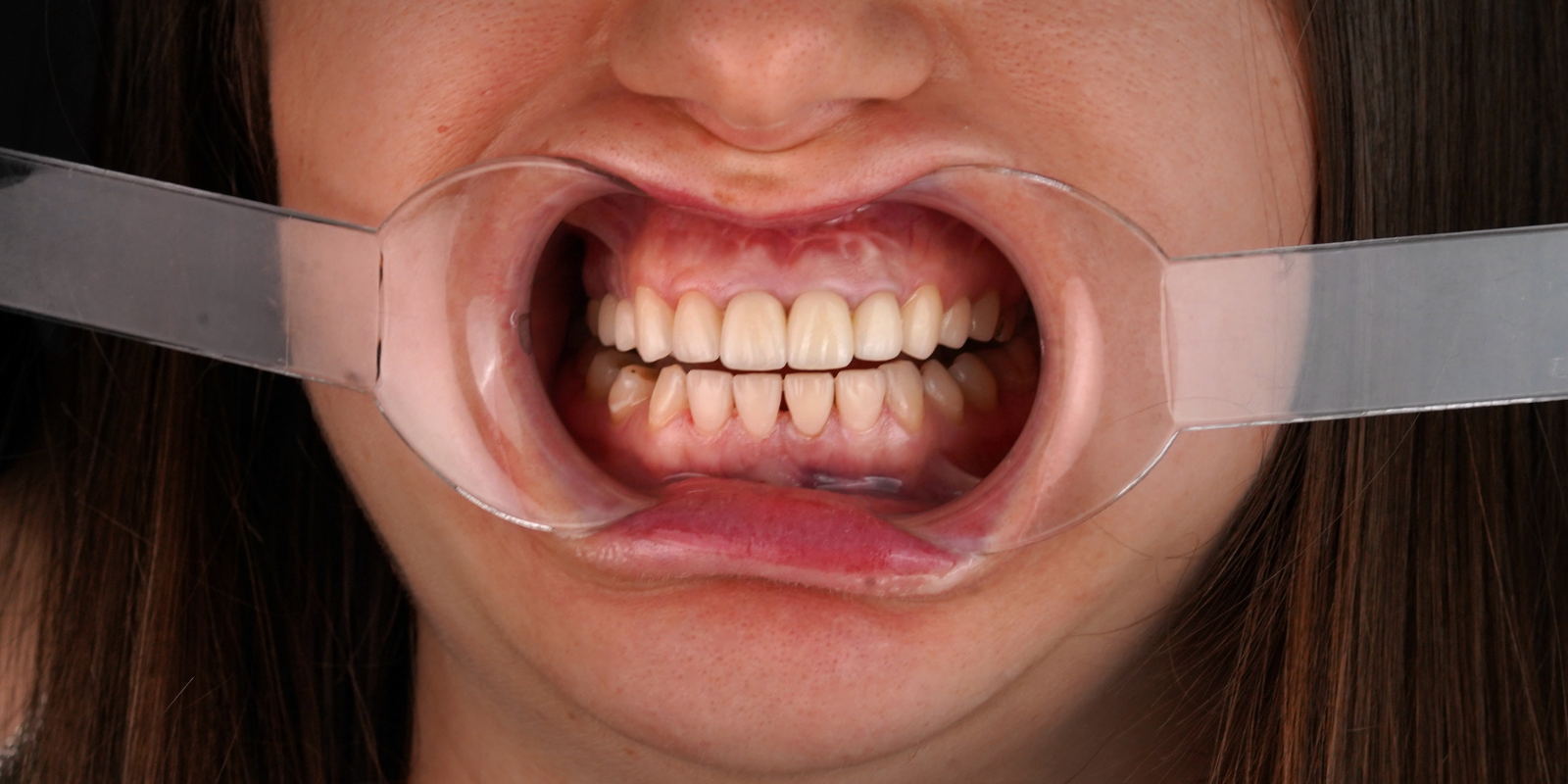 Керамічні вініри й коронки всього за 1 тиждень