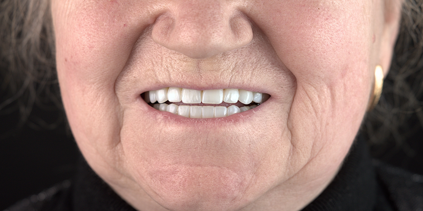 Від знімних протезів до імплантів Straumann в 73 роки