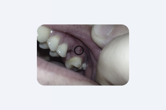 Удалили зуб – советы по уходу после процедуры