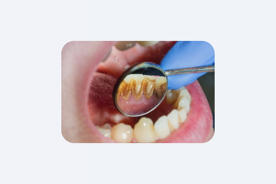 Чому у деяких людей зубний камінь з’являється швидше?