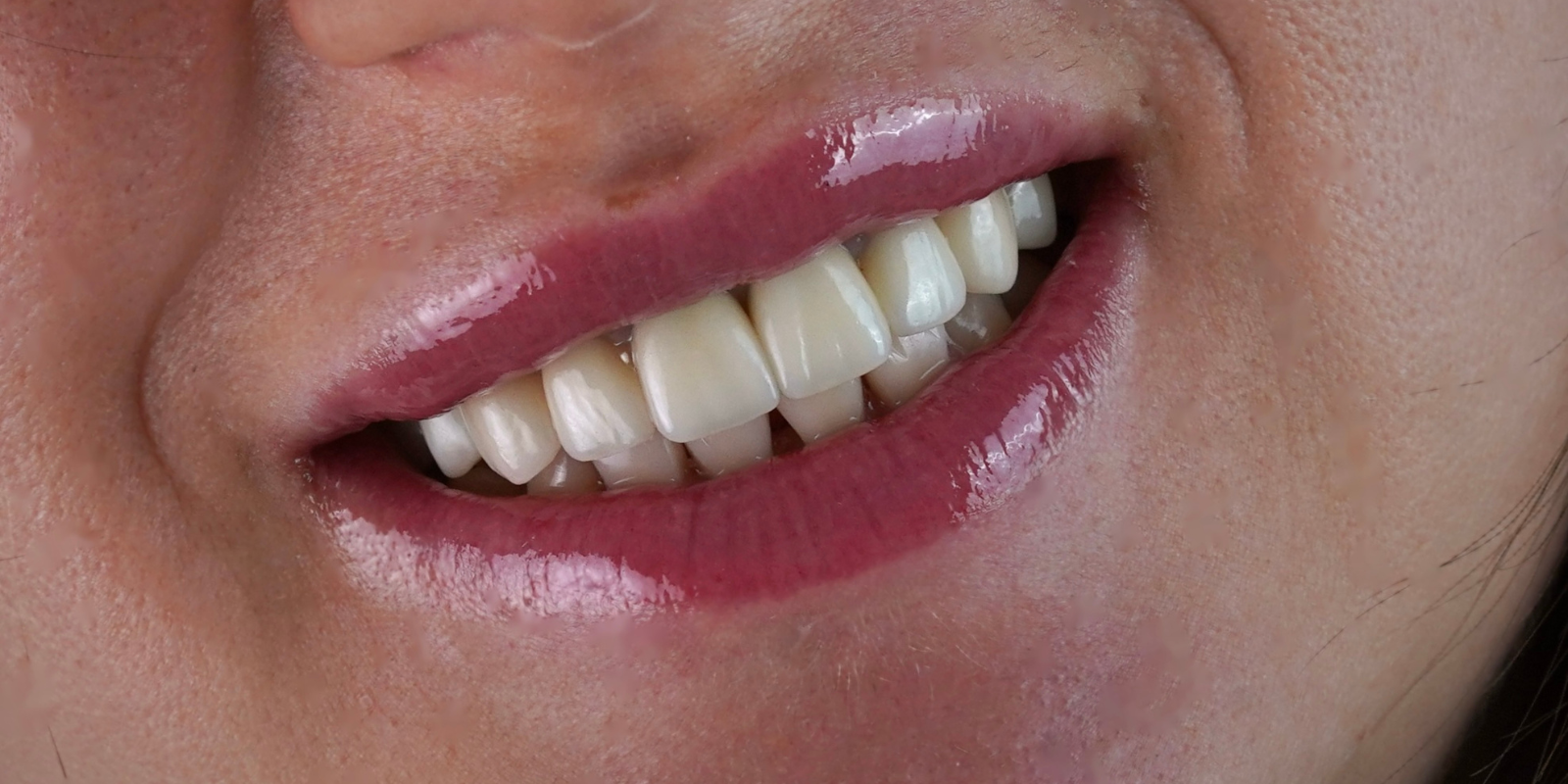 Керамічні вініри й коронки всього за 1 тиждень