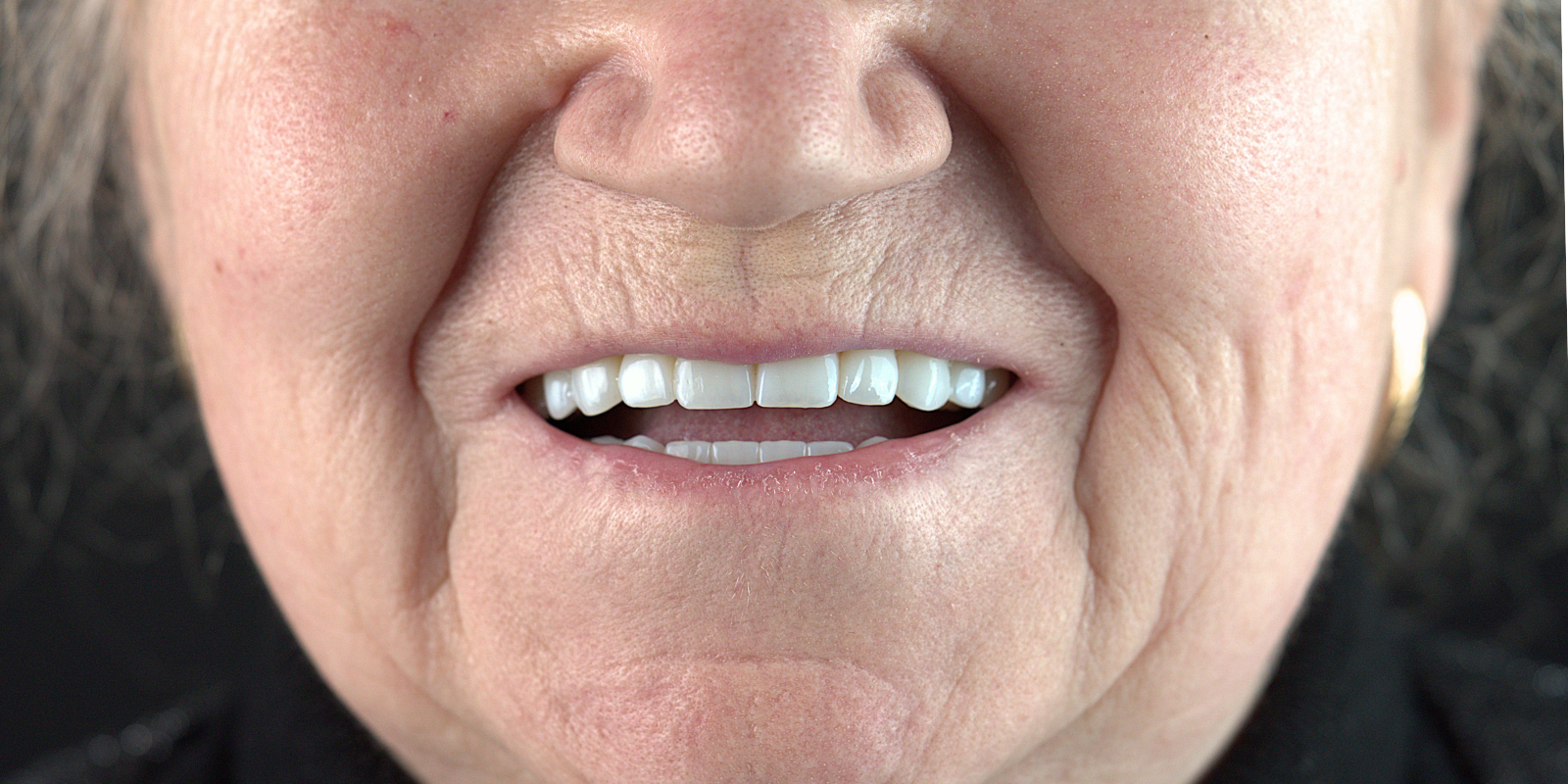 Від знімних протезів до імплантів Straumann в 73 роки