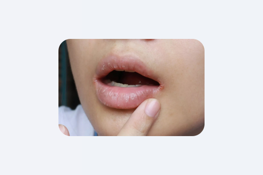 Зуби руйнуються без болю: правда, яку ігнорують