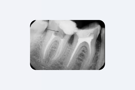 Зуби руйнуються без болю: правда, яку ігнорують