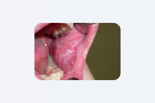 Зуби руйнуються без болю: правда, яку ігнорують