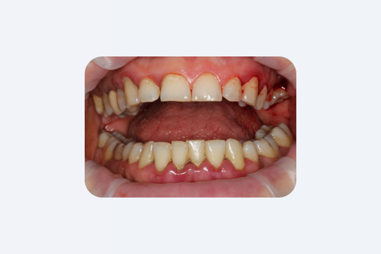 Зуби руйнуються без болю: правда, яку ігнорують