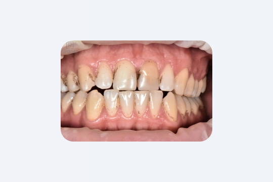 Зуби руйнуються без болю: правда, яку ігнорують