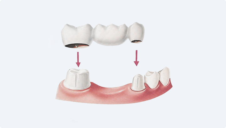 Чому імплант може не прижитися та що в такому випадку робити