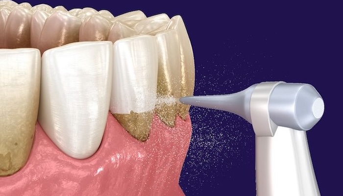 Професійна чистка зубів