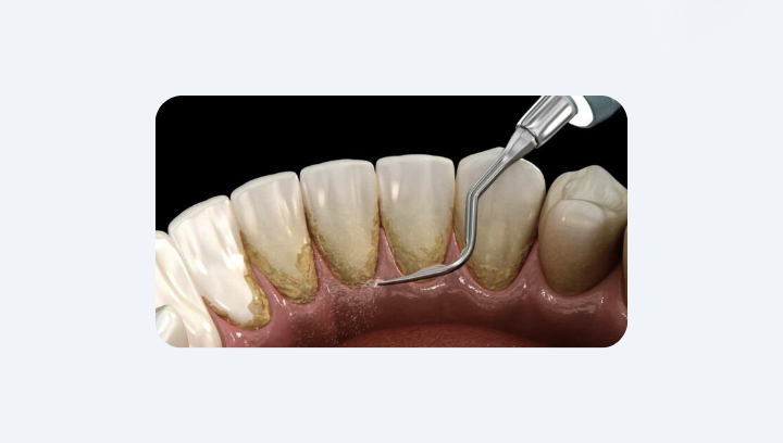 Імплант може прослужити понад 20 років: 5 ключових умов