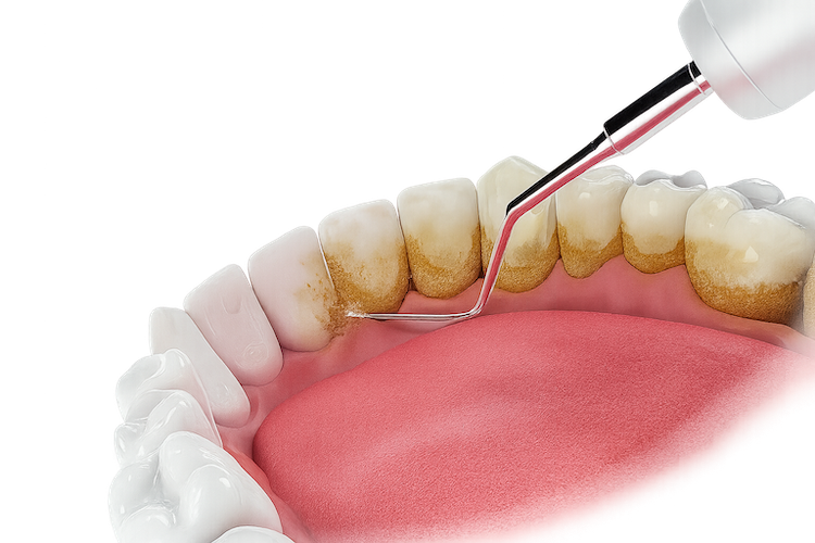 Професійна чистка зубів