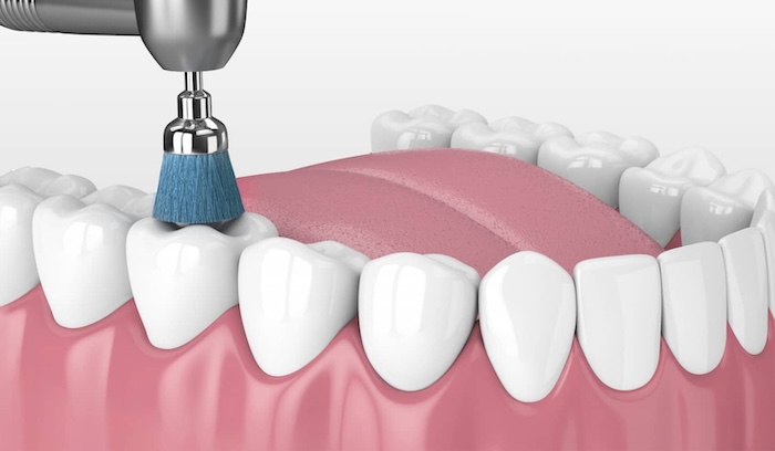 Професійна чистка зубів