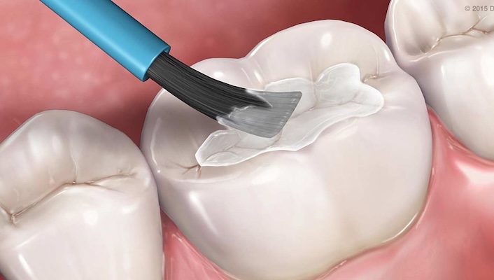 Професійна чистка зубів