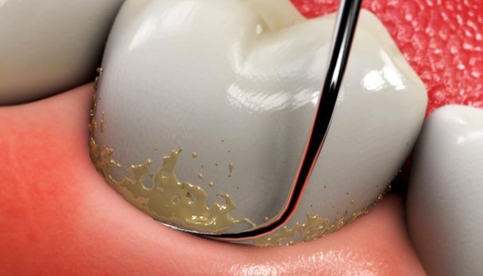 Професійна чистка зубів