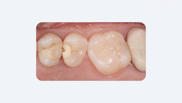 Як розпізнати проблему з пломбою самостійно