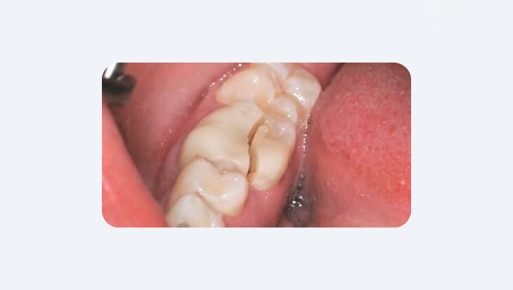 Як розпізнати проблему з пломбою самостійно