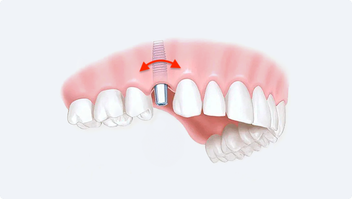 Чому імплант може не прижитися та що в такому випадку робити