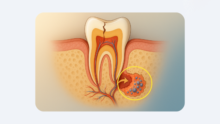 Кіста зуба: коли можна вилікувати, а коли — видаляти