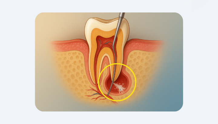 Кіста зуба: коли можна вилікувати, а коли — видаляти
