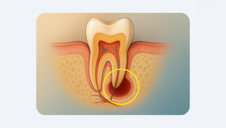 Кіста зуба: коли можна вилікувати, а коли — видаляти