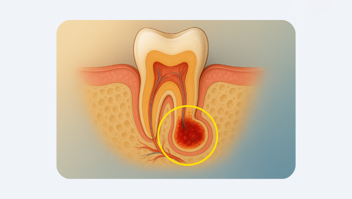 Кіста зуба: коли можна вилікувати, а коли — видаляти