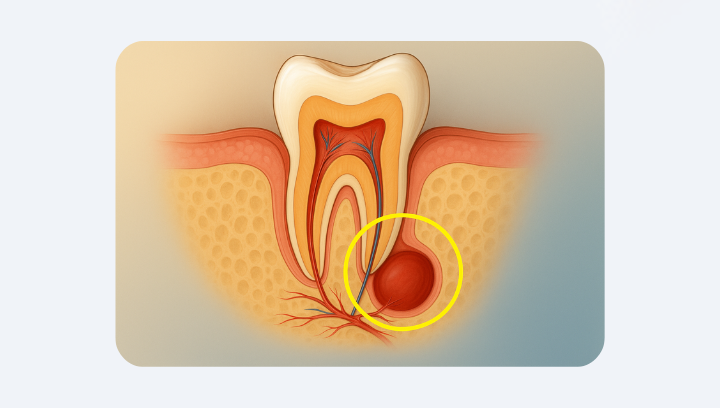 Кіста зуба: коли можна вилікувати, а коли — видаляти