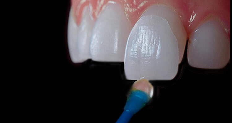 Вініри на зуби: як створюють голлівудську усмішку