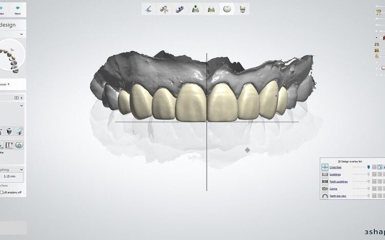 Вініри на зуби: як створюють голлівудську усмішку