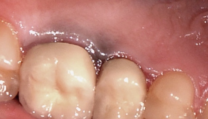 Коли потрібно міняти стару пломбу?