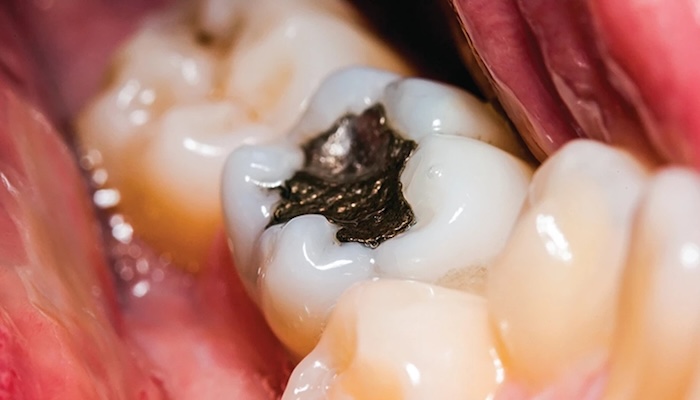 Коли потрібно міняти стару пломбу?