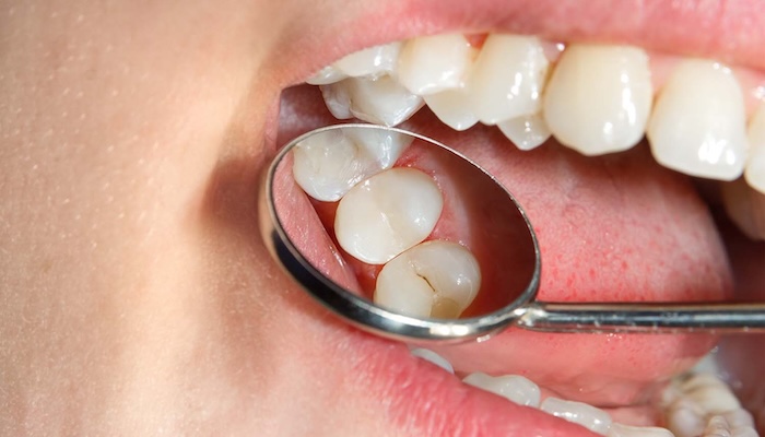 Коли потрібно міняти стару пломбу?