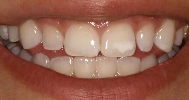 Ранняя стадия деминерализации когда кислоты, которые производят бактерии из сахаров, вымывают кальций и фосфаты из эмали