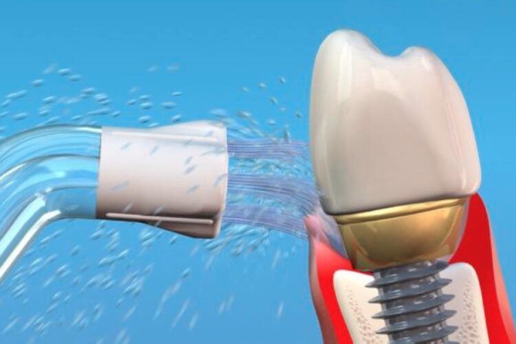 Для догляду за імплантатами призначені спеціальні пародонтальні або імплантологічні насадки.