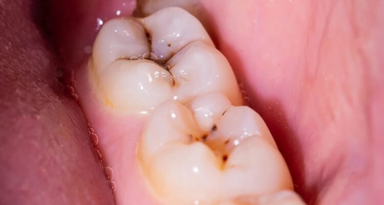 Тёмные точки или полоски на жевательных поверхностях или между зубами