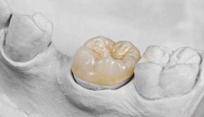 Коли потрібно міняти стару пломбу?