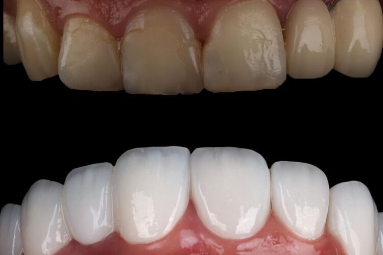 Вініри на зуби: як створюють голлівудську усмішку