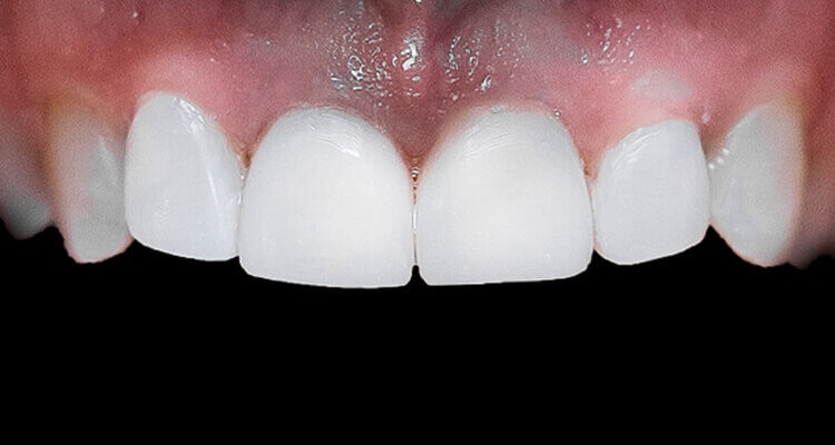 Вініри на зуби: як створюють голлівудську усмішку