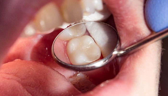 Коли потрібно міняти стару пломбу?