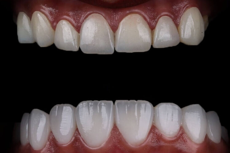 Вініри на зуби: як створюють голлівудську усмішку